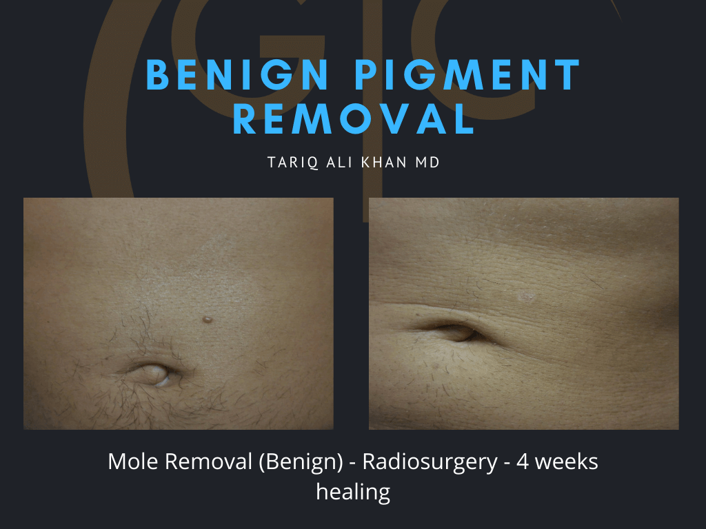 Gentle Care Laser Tustin Before and After picture - Mole Removal